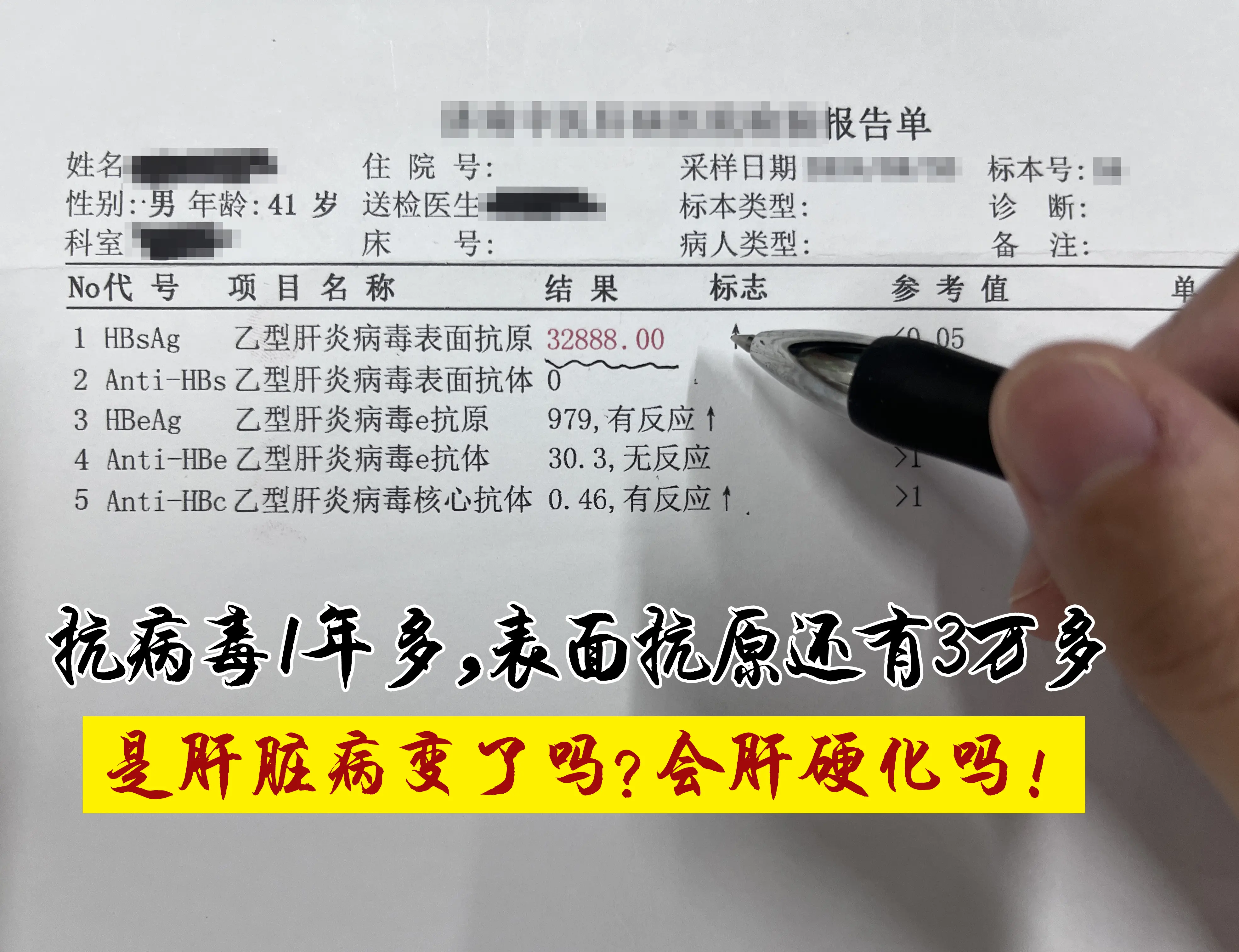 前段时间接诊了一位小伙，抗病毒治疗1年半，大三阳，乙肝表面抗原仍高达3...