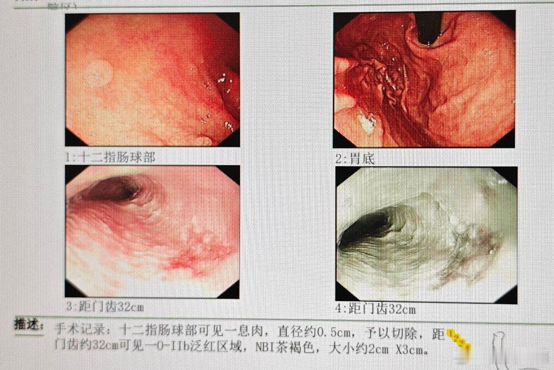这个食管病变，最后得病理是鳞状细胞癌，还好在黏膜固有层。本来是做胃息肉的，过食管