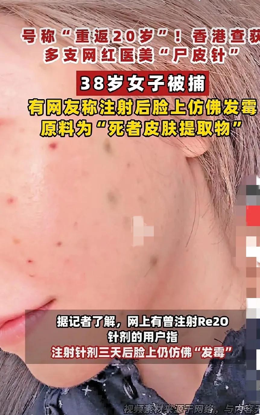哎呦，为美不要命啊！“尸皮针”，听名字就鸡皮疙瘩掉一地，靓女们为美不要命了，削毸