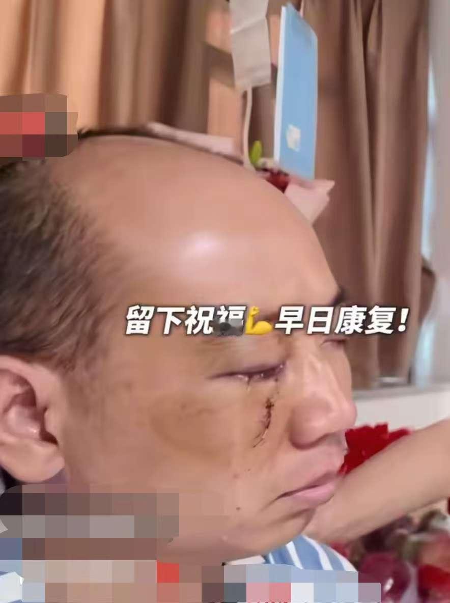 终于有后续了！
让人高兴的好消息来了，
被玻璃刺伤双眼的公交司机不仅左眼无大碍，