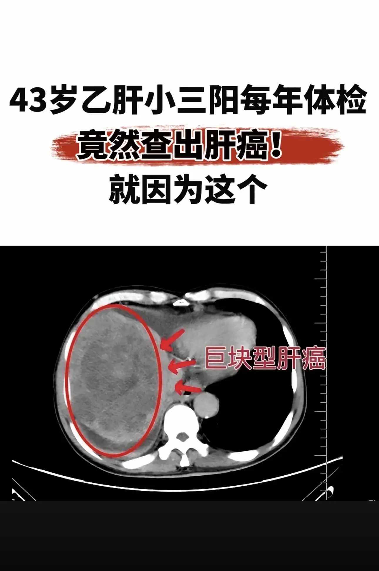 乙肝小三阳每年体检，竟然查出肝癌！临沂的一个病号，这个病号也是很可惜很...