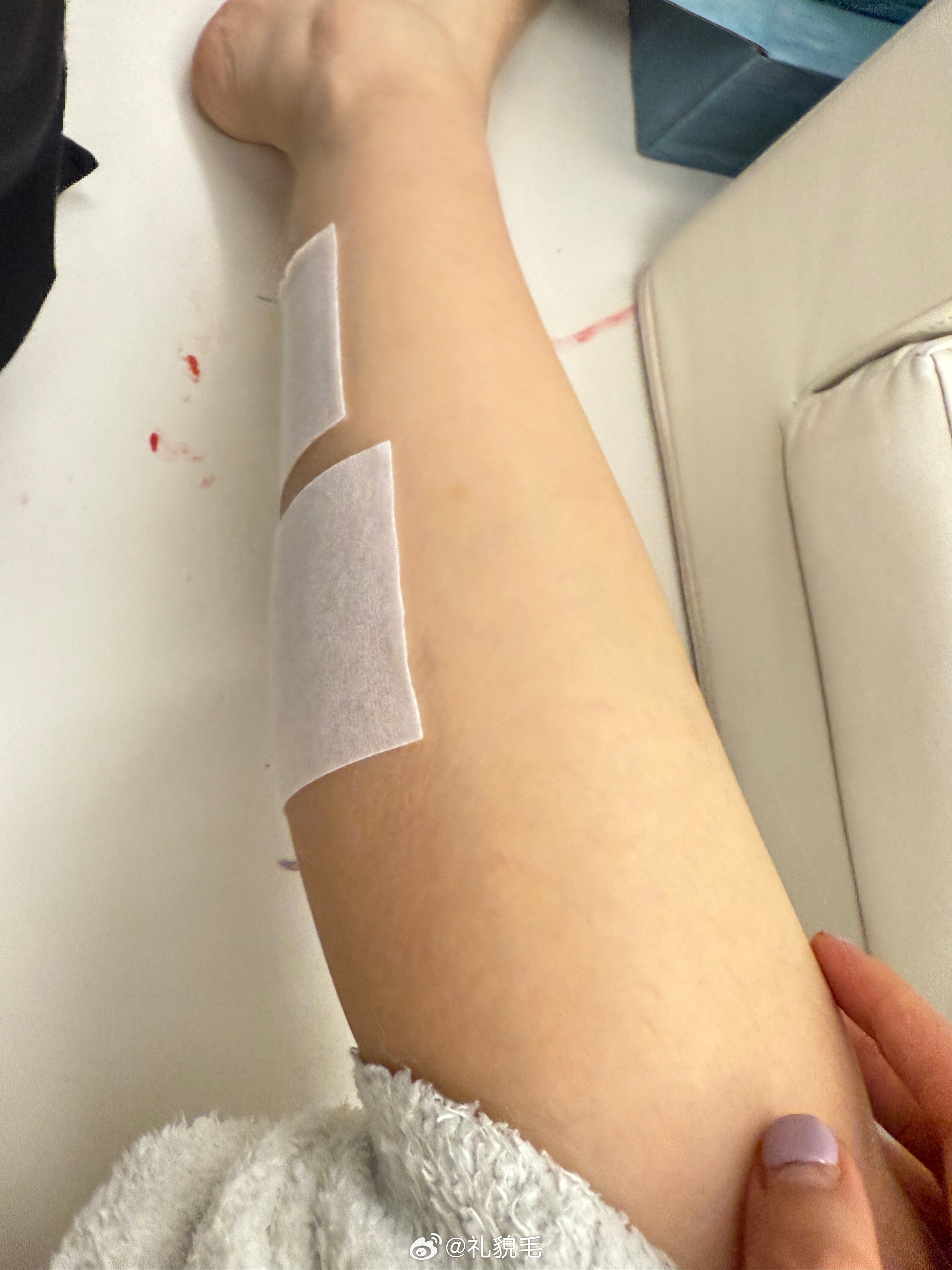 摔了一跤左肩破了，左小腿胀痛但我肚子饿了