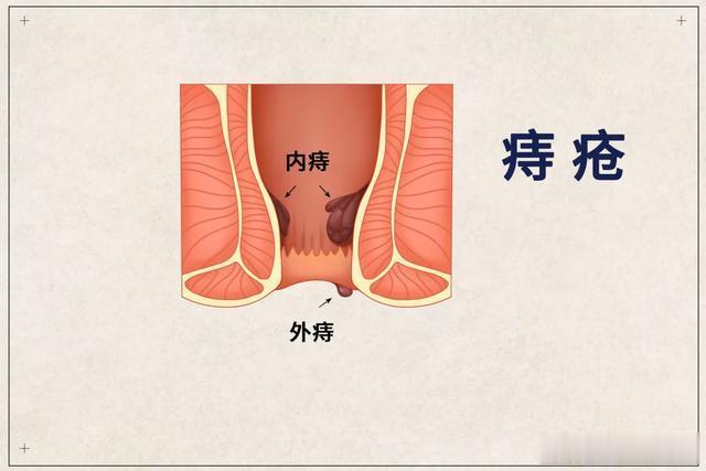 痔疮复发，可能是下面三个原因！1、饮食不当：可能是由于长期过量食用辛辣刺激性食物