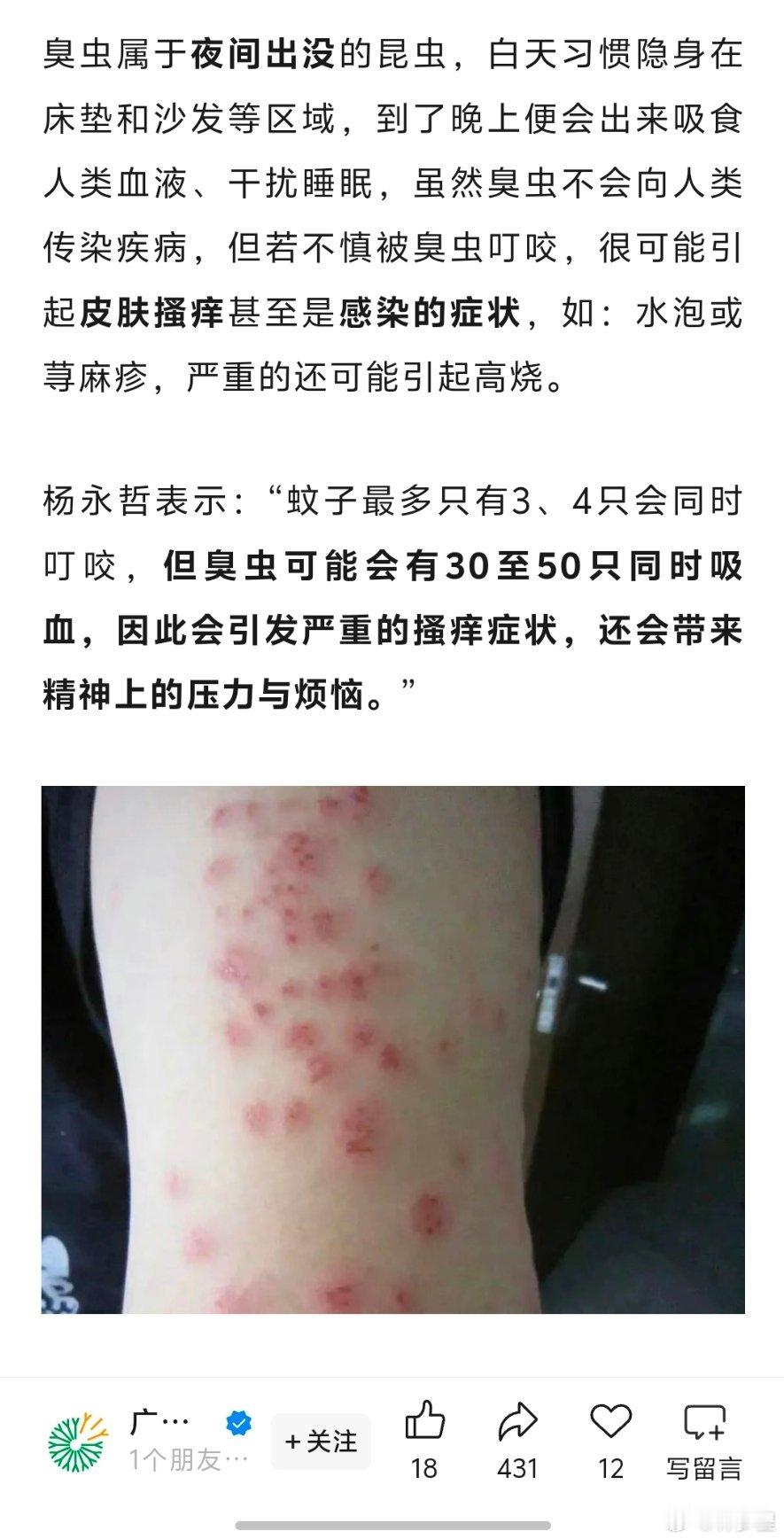 几乎绝迹床虱又出现了臭虫可能会有30至50只同时叮咬[惊恐]。起鸡皮疙瘩了[裂开
