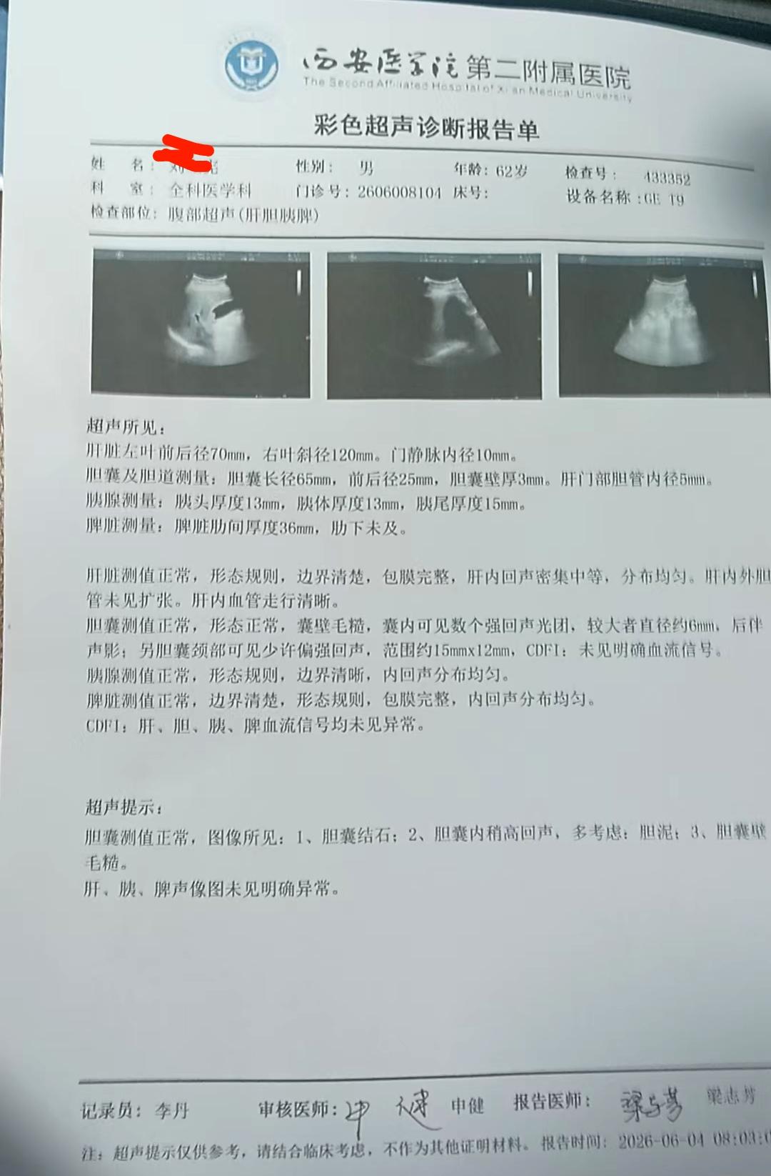 胆结石用三种药混喝起作用吗？
我2023年检查胆囊结石1.8㎝，喝了近一年煮红茶