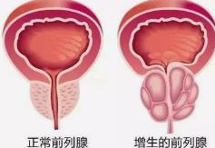 管好前列腺，幸福无极限——前列腺增生中医治法

前列腺问题固然让人头疼，但老话说