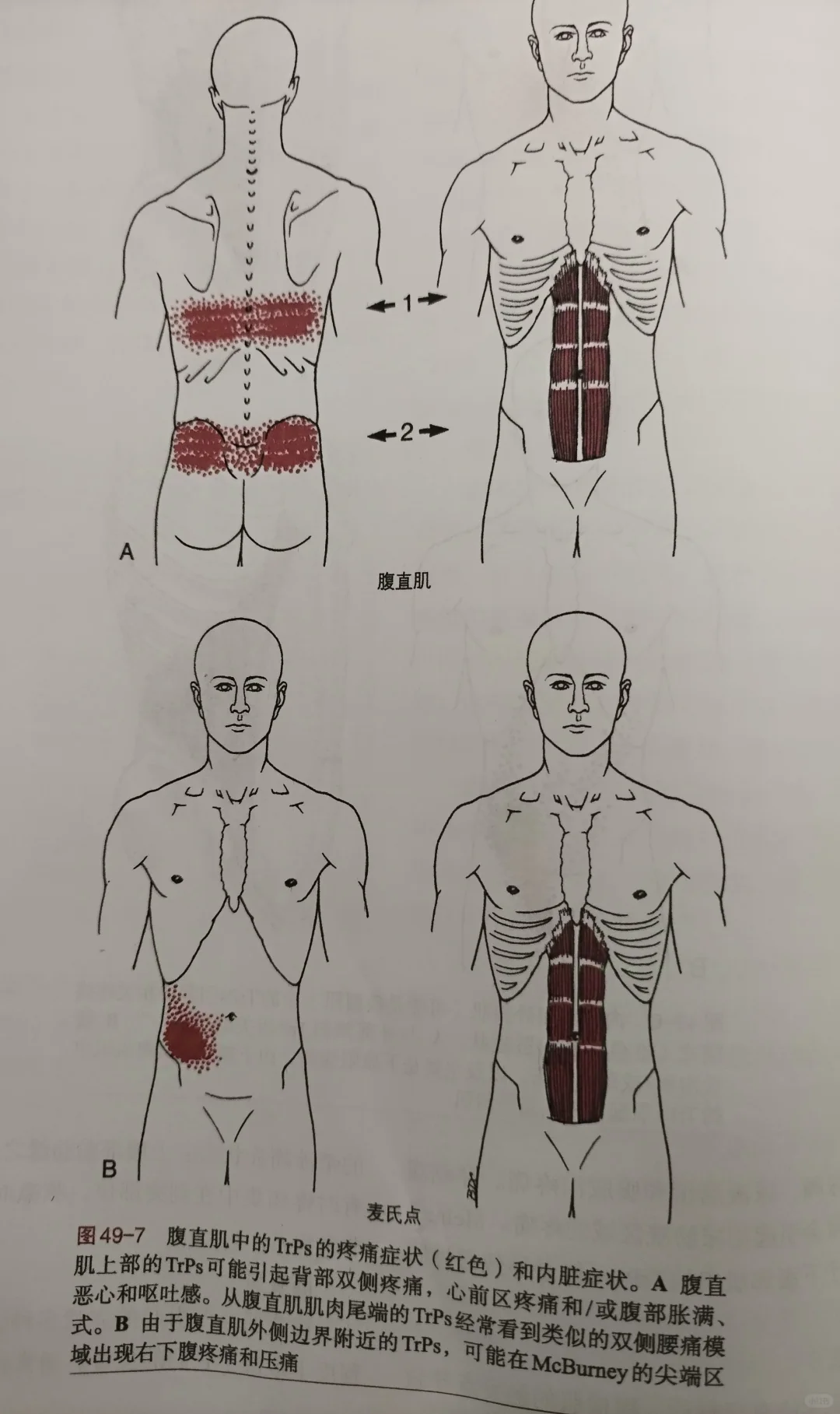 腹横肌和腹直肌触发点表现