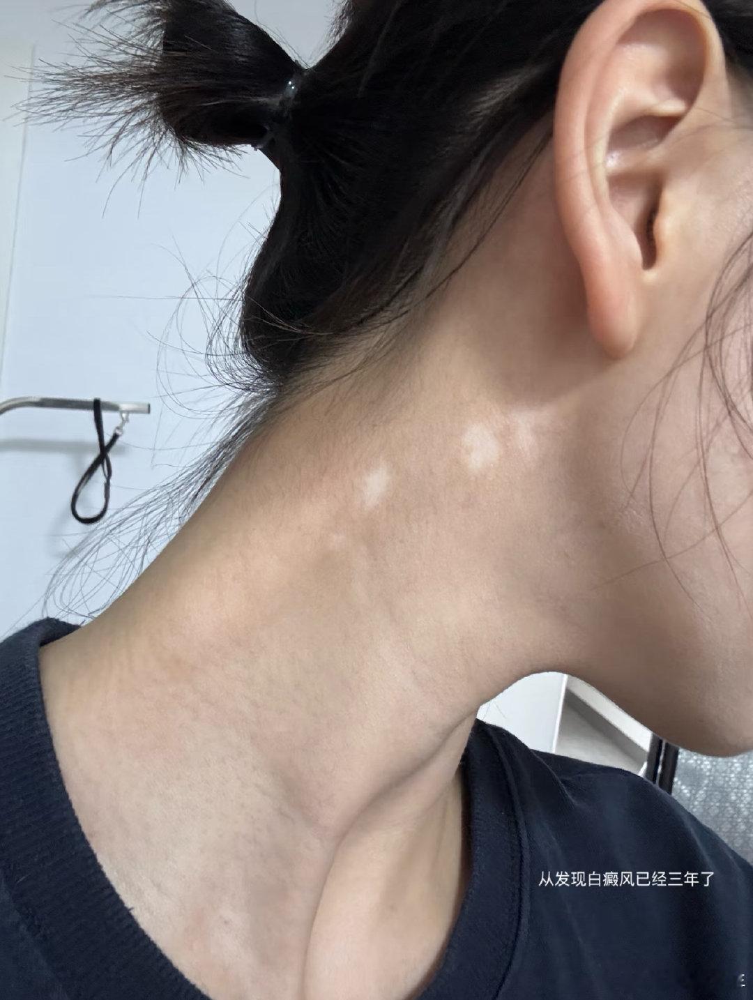 金子涵晒近照 金子涵说从发现白癜风已经三年了，我的天呢…金子涵说从发现白癜风已经