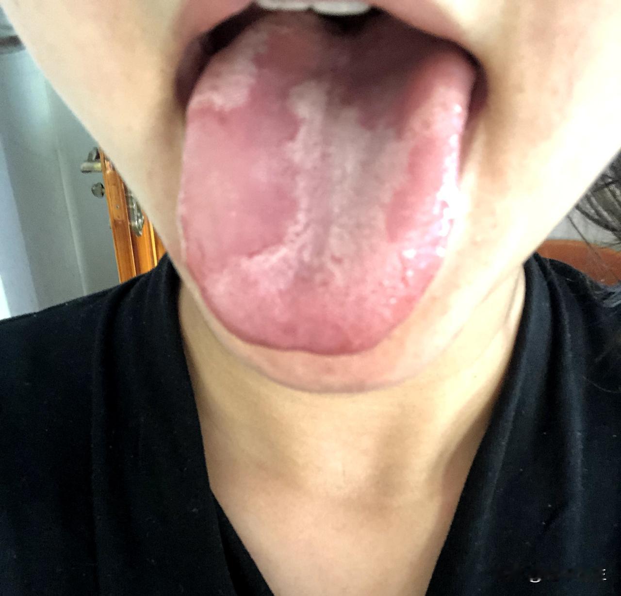 真不知道这个小伙子怎么弄的，舌苔都掉落成这样了，还不赶紧调理吧
今天看诊这样一个