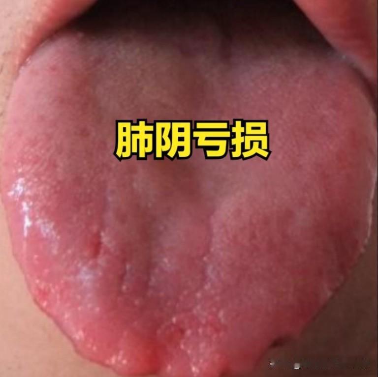 嗓子干，嗓子痒，嗓子总有痰？不一定是咽炎，很可能是这3种病！

1、肺有病
中医