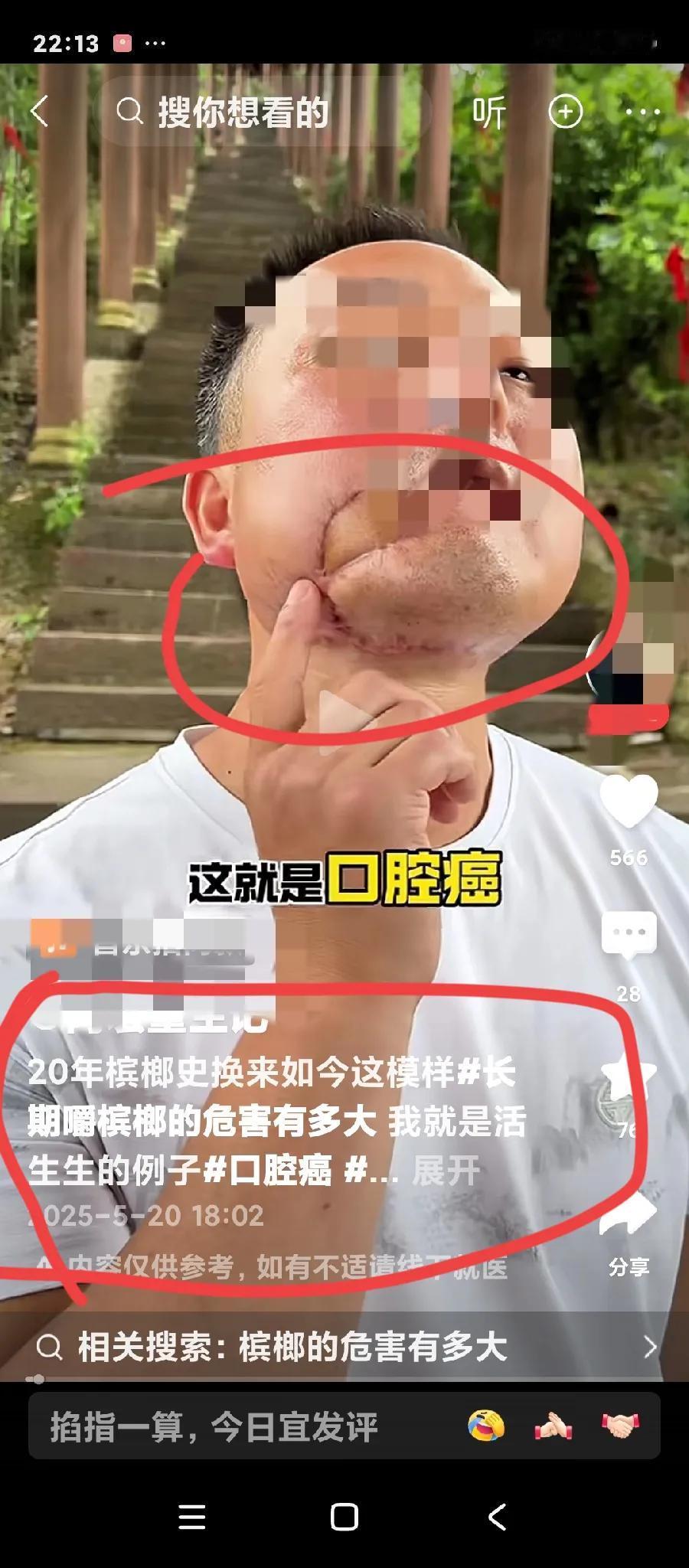 这个口腔癌术后患者说道，当初听不进他人的劝告，特别爱吃槟榔，白天吃，晚上也吃，一
