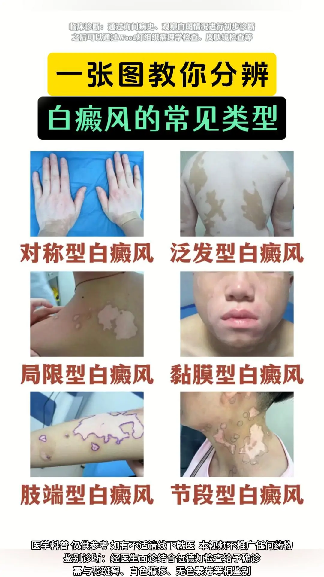医学科普 白癜风 白癜风科普 白斑 硬核健康科普行动