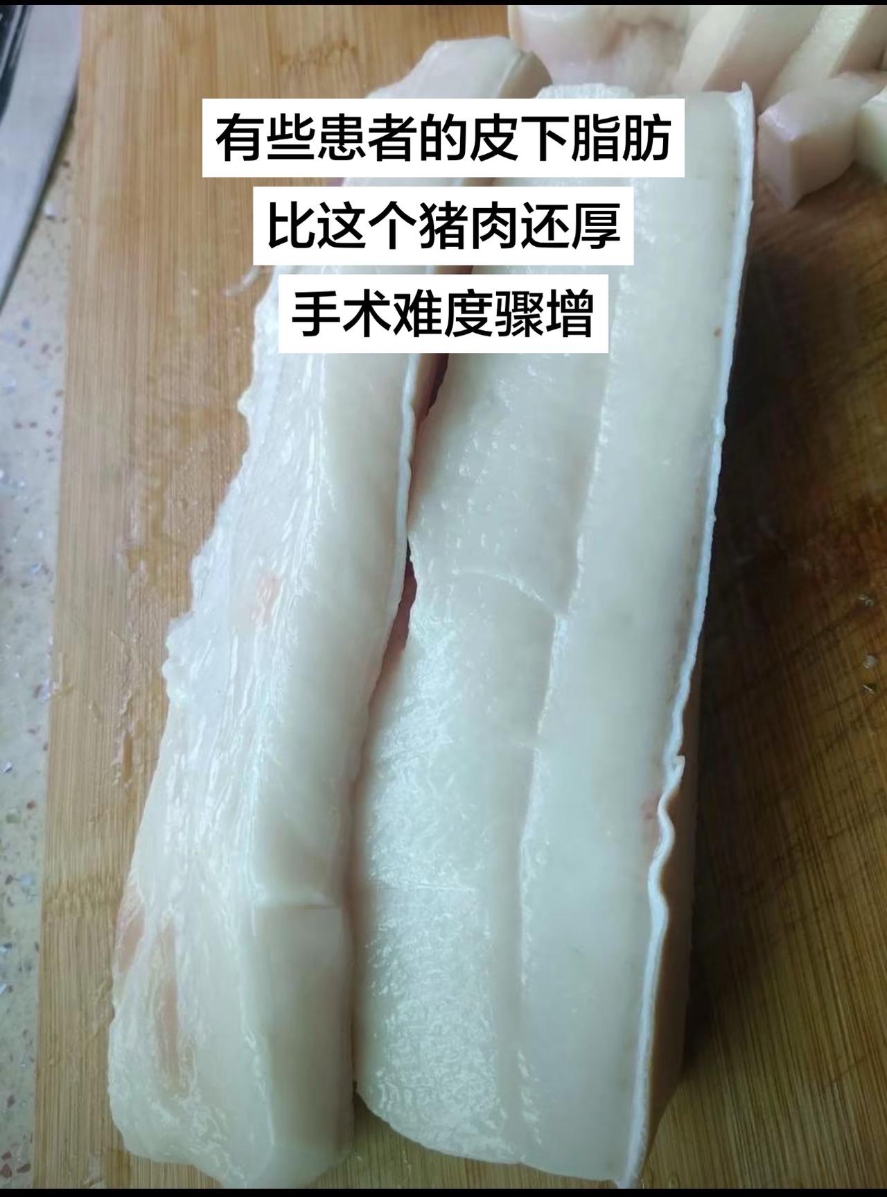 肥胖增加手术难度，术后更容易出现伤口感染，脂肪液化，切口咧开和切口疝等并发症