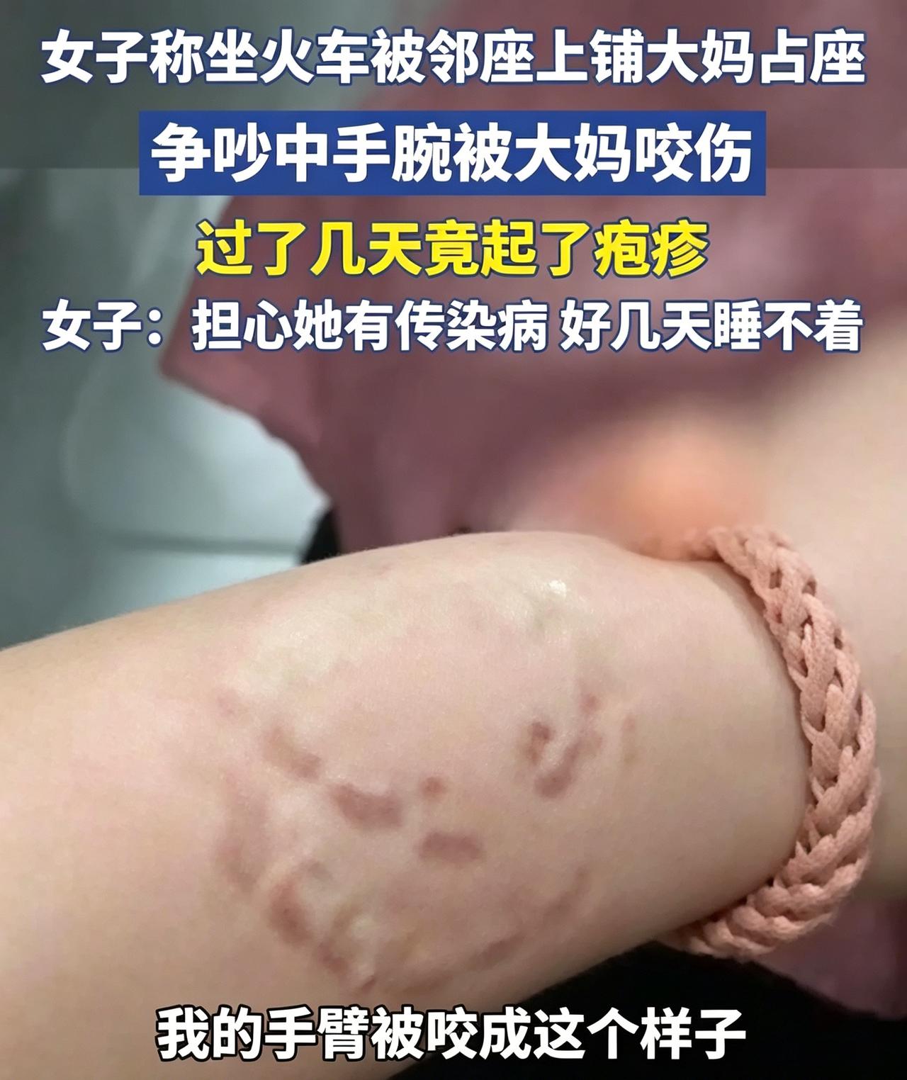 女子火车卧铺遭霸座大妈咬伤，
涉事大妈拒交体检报告，维权比找凶还难！
近日，一则