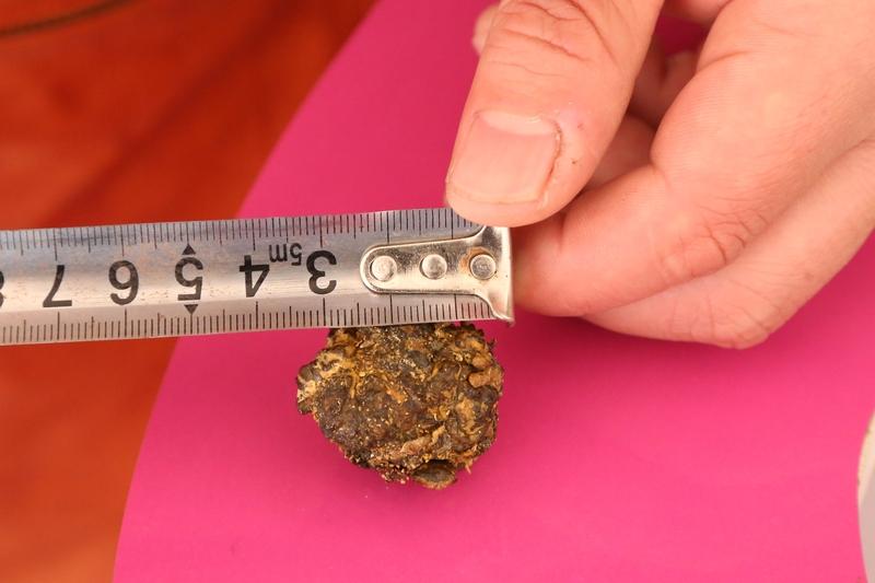 久病可以成医，你还别不信。我用两次深夜的剧痛告诉你，结石也是可以预防或者扭转的