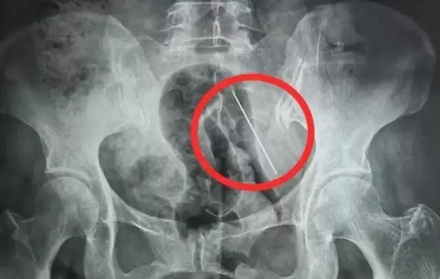 近日陕西60岁的张某经历了一场惊险。她平时爱缝补，2月某天缝完被子，随手把4厘米