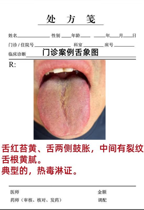 前段时间一位粉丝患者通过后台私信，来到了我的门诊上，最开始是发给我的舌象照片，后