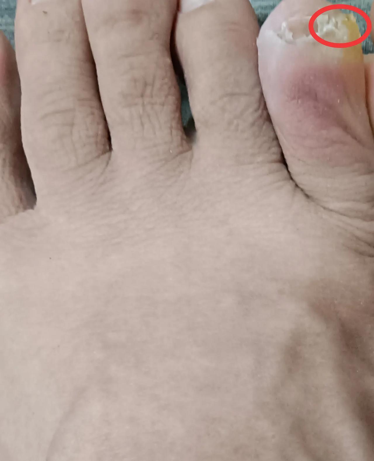我的小拇趾外侧长了一块类似指甲的东西（见图片圆框圈起地方），稍微一碰就疼得厉害，