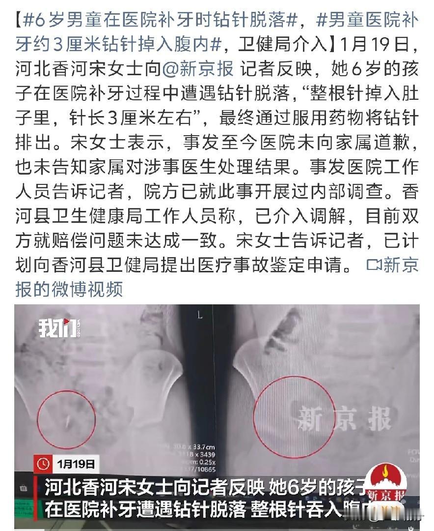 河北香河一名6岁男童补牙时，牙科钻针意外脱落并掉入腹腔。钻针长达3厘米最终通过药