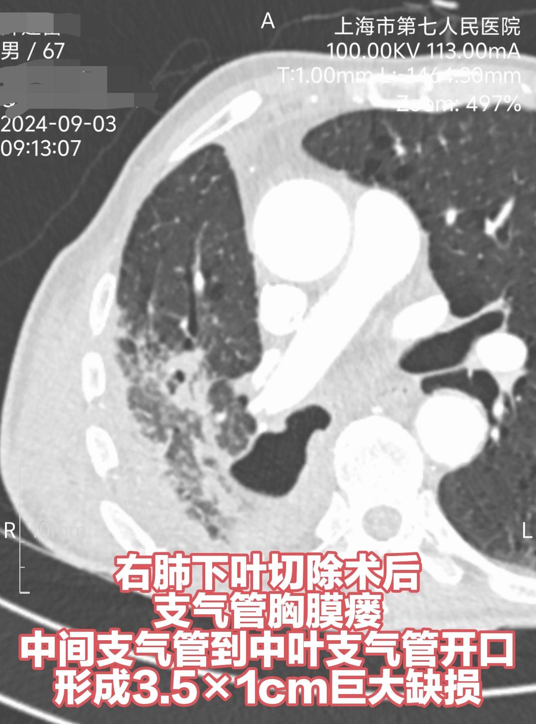 继2年前一次手术修补支气管胸膜瘘和食管瘘之后，七院胸外科今日再次完成壮...