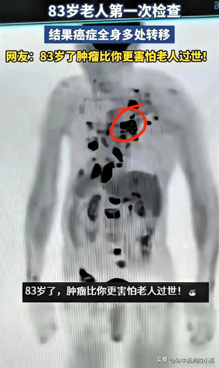真的太出乎意料了！
83岁大爷生平首次做全身体检，
竟查出癌细胞全身转移！
可老