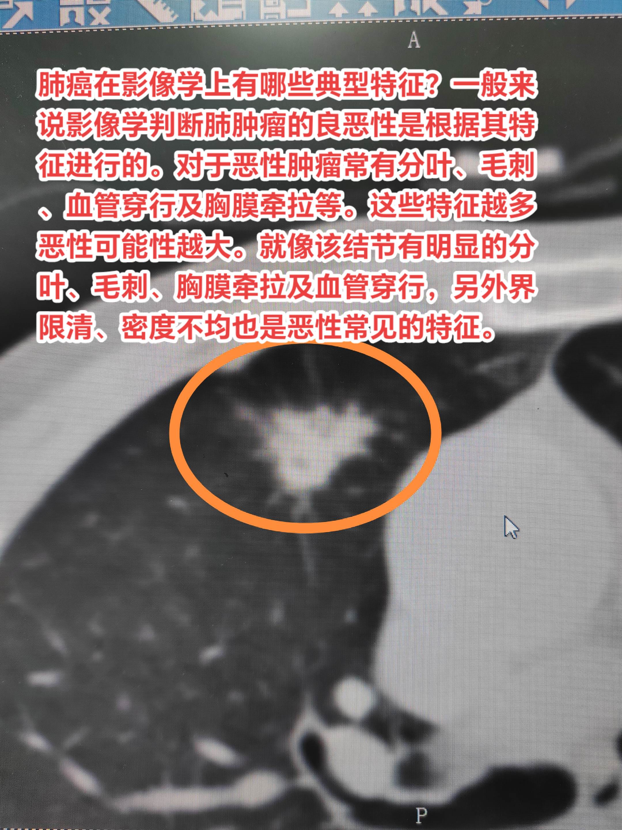 肺癌在影像学上有哪些典型特征？一般来说影像学判断肺肿瘤的良恶性是根据其...