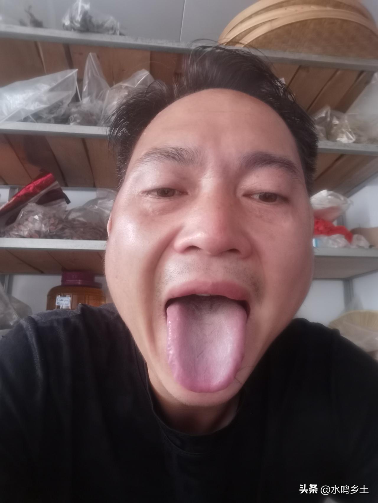 熬夜有多伤身体，坚持三个月，齿痕舌就出来了，舌边鼓胀，肝气不疏，齿痕舌，脾虚气也