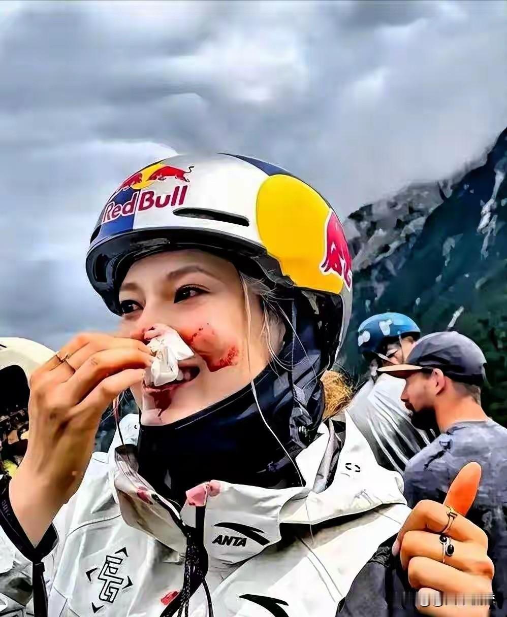 2025年1月25日，谷爱凌在美国阿斯本雪道出事，头部撞击雪面后昏迷，经历急性颅