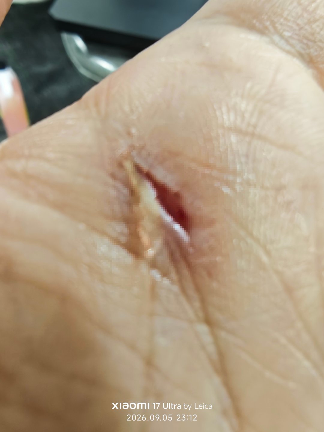 太惨了，今天直接被一块玻璃割掉了手掌✋🏻一块肉……打码后看到还这么深，你们就知