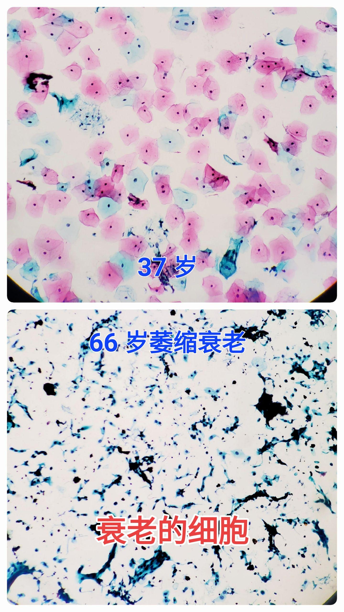 衰老的宫颈鳞状上皮