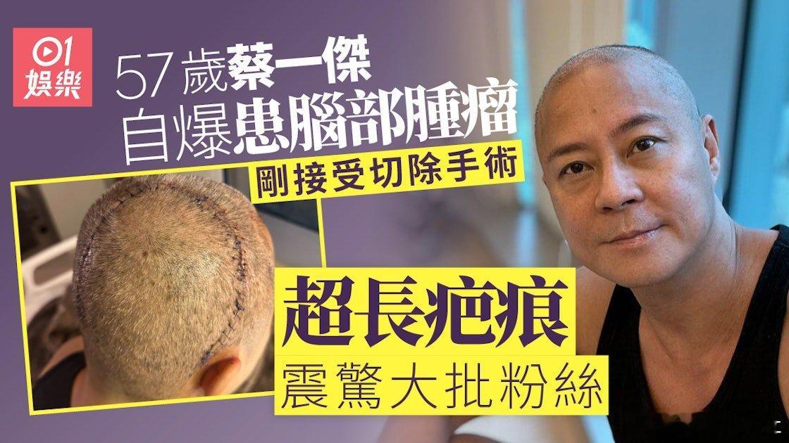 現年57歲的蔡一傑今日（20日）在Instagram透露自己剛剛完成一個切除腦部