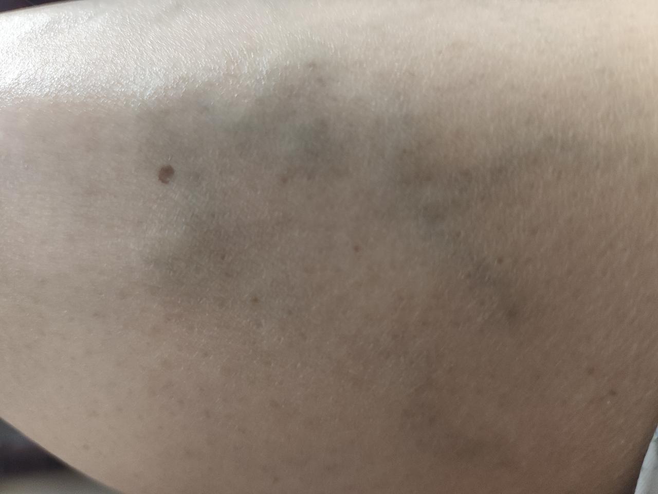 有一件事在我心里好久了，让我有一点担心。

是这样的，我的小腿部有很粗的蚯蚓血管
