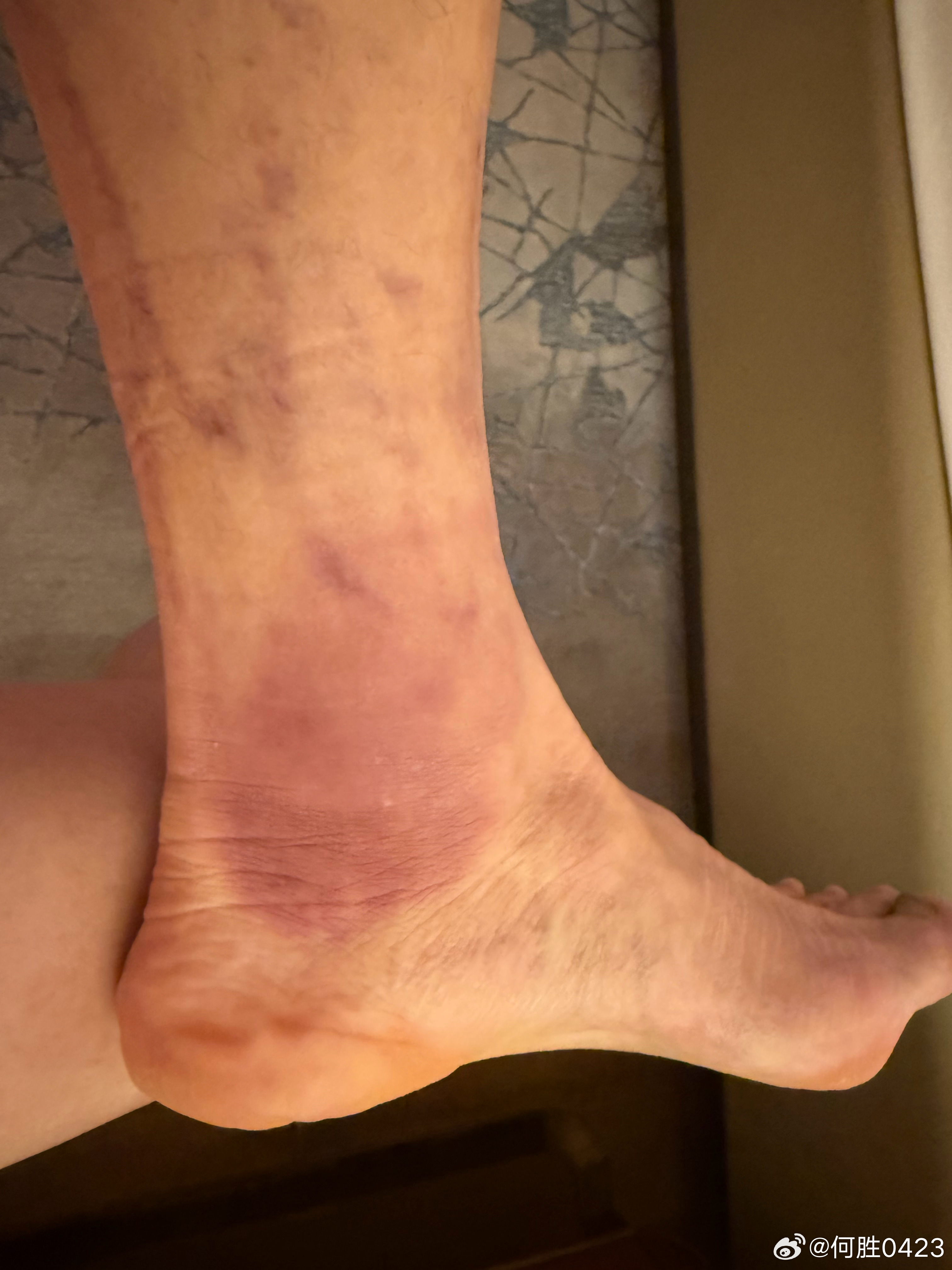 这腿是不是要废了