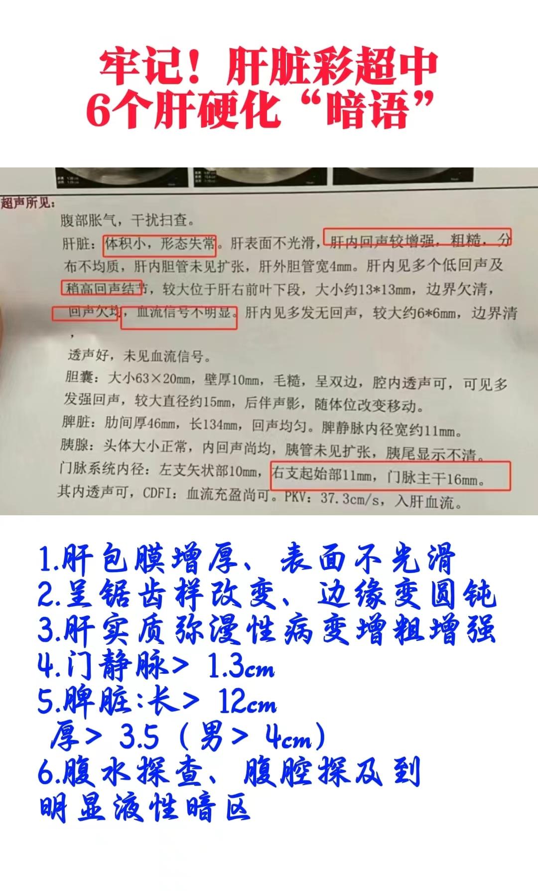山东 肝硬化 医学科普