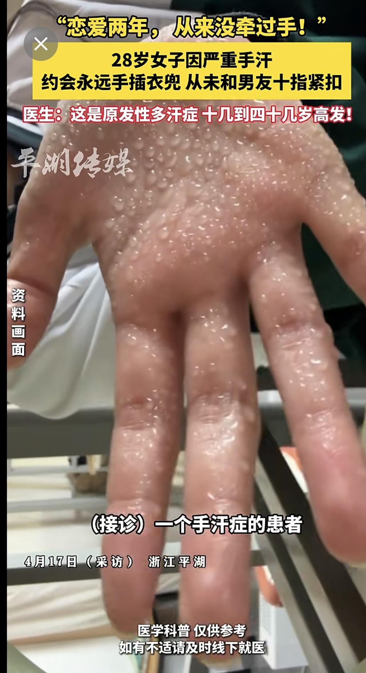 “恋爱两年， 从来没牵过手！”28岁女子因严重手汗，约会永远手插衣兜，从未和男友