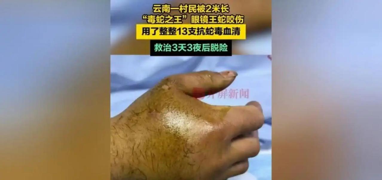 锄头砍断了2米长的眼镜王蛇，可这条命，差点没保住。

云南昭通鲁甸县梭山镇，一名