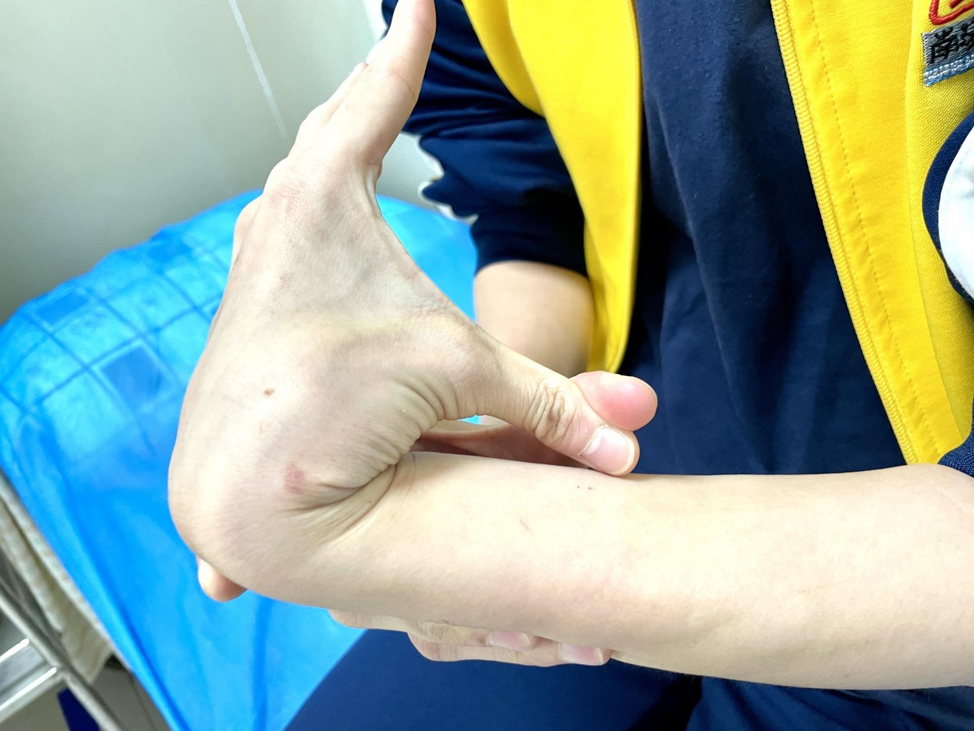 多韧带松弛症。“ 鱿鱼女孩 ”，这类女性患者共同的体征 ，周身韧带松弛 ，关节活动超过正常范围，运动容易扭伤，你有吗？