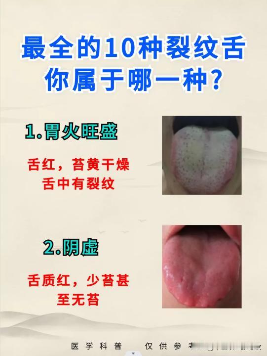 舌头上有裂纹，提心吊胆，不知道怎么办
最普遍的10种裂纹舌，5张图带你分清楚
张