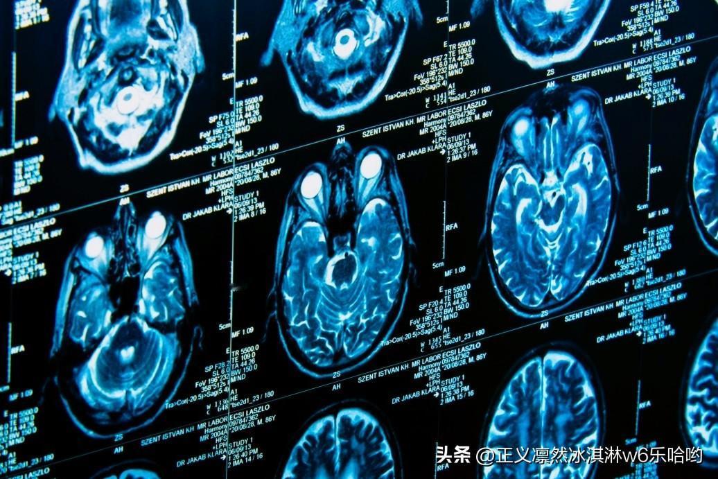 🍒人工智能技术对意识障碍患者大脑的“意识开关”展开分析，揭示了意识恢复的共性神