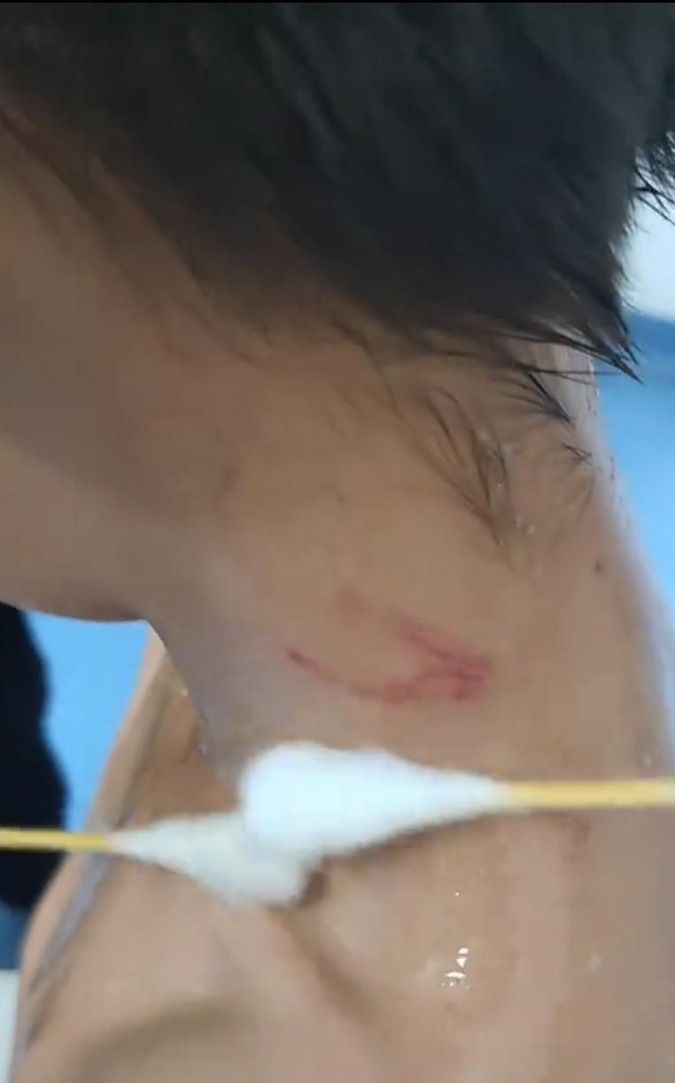【#黔灵山回应男孩竖中指被猴群抓伤# 或是无心之举，酌情报销】#7岁男孩疑对猴子