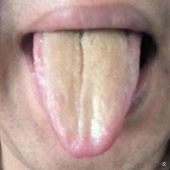 20多岁裂纹就这么明显，还是年轻啊，就使劲造吧[发怒][发怒]
说了不听，听又不