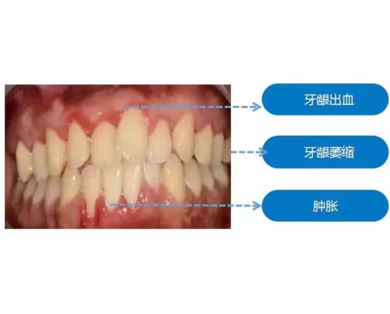 牙龈萎缩患者的福音[good]#中医式生活#  【主治】牙龈萎缩【配方】大蒜头1