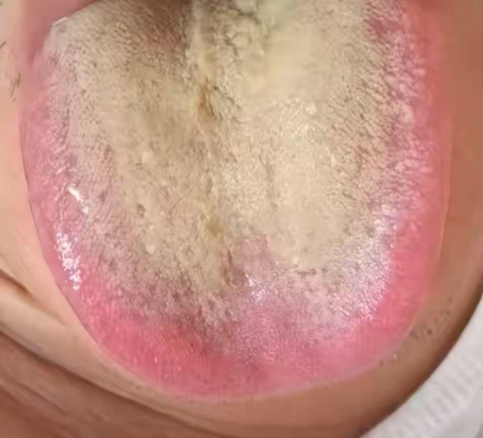 肝郁一解，湿热全消！1个中成药，疏肝理气，清退体内湿热！

常年口干口苦，晨起嘴