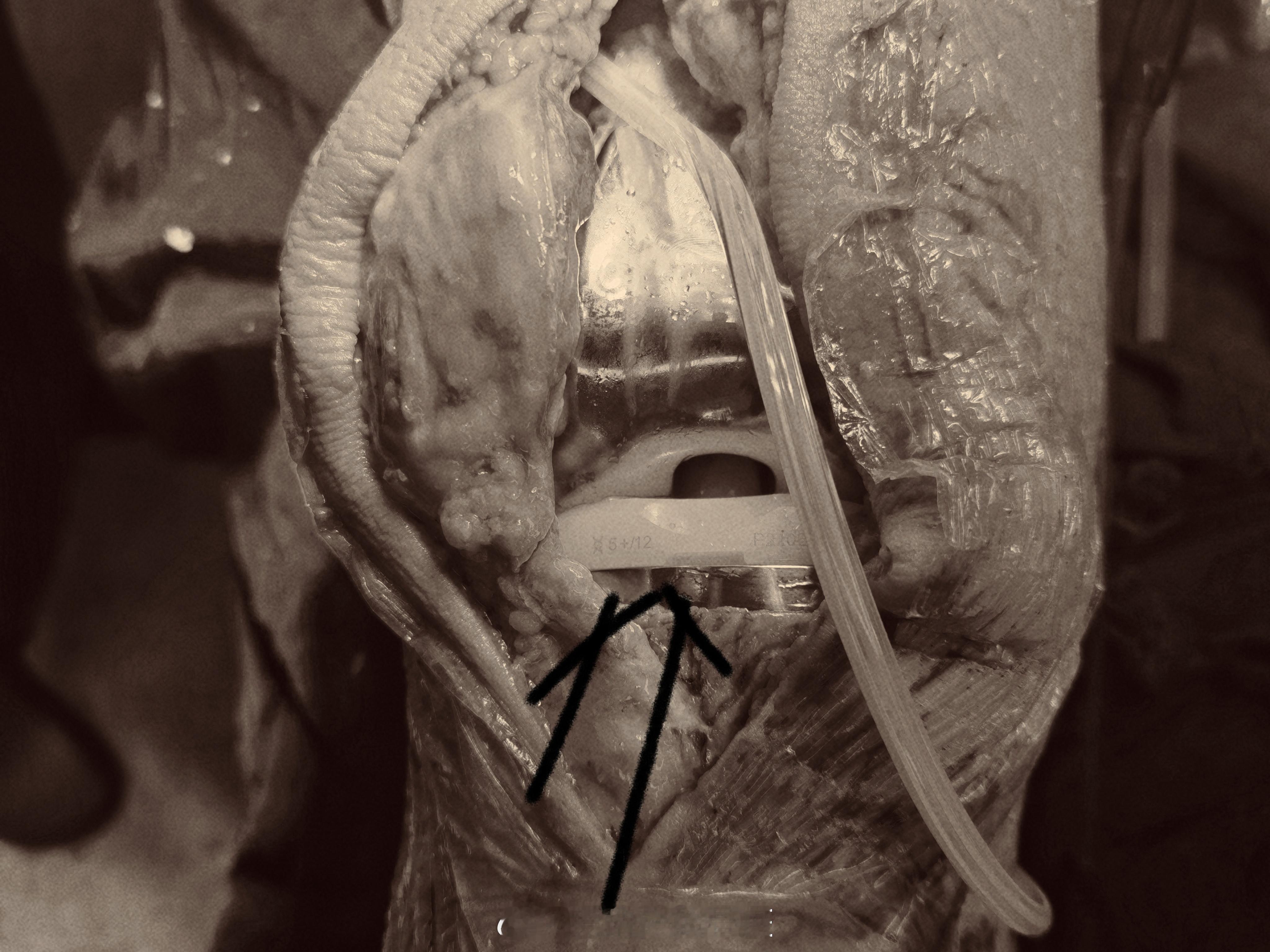 今天又脑残了，徒手一劈，垫片虽然安进去了，但小鱼际又肿了，下次说啥也要用锤子……