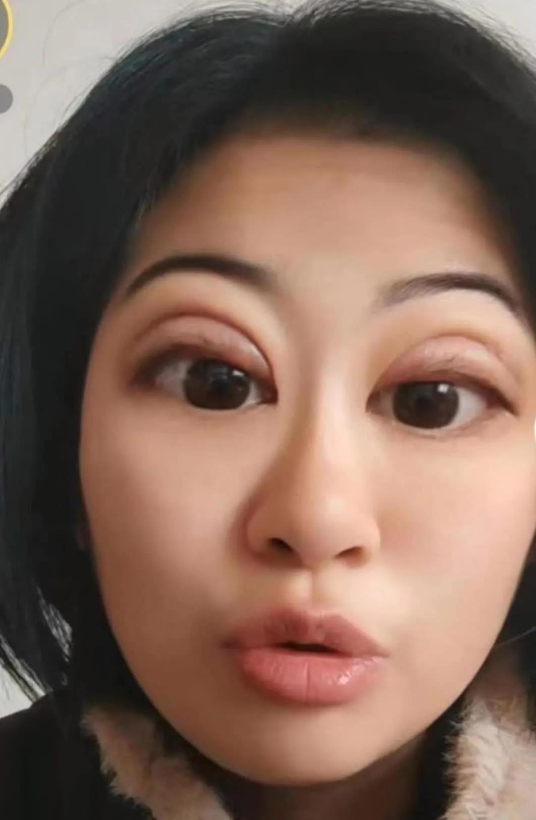 这双眼皮做的太美了！此眼皮只应天上有。
#双眼皮手术术后# 
#春日生活打卡季#