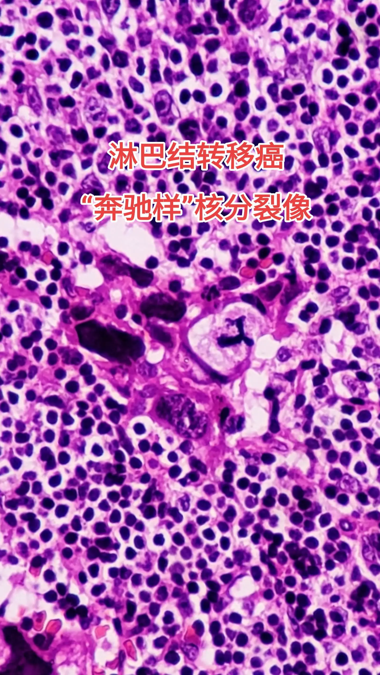 乳腺癌