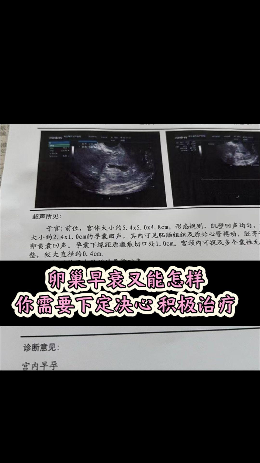 卵巢早衰需要积极治疗！