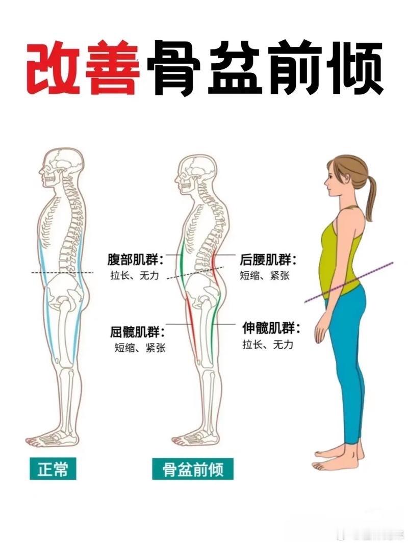 当你骨盆前倾时，除了影响体态，你会：1.腰部竖脊肌、髂腰肌持续紧张，可能引发僵硬
