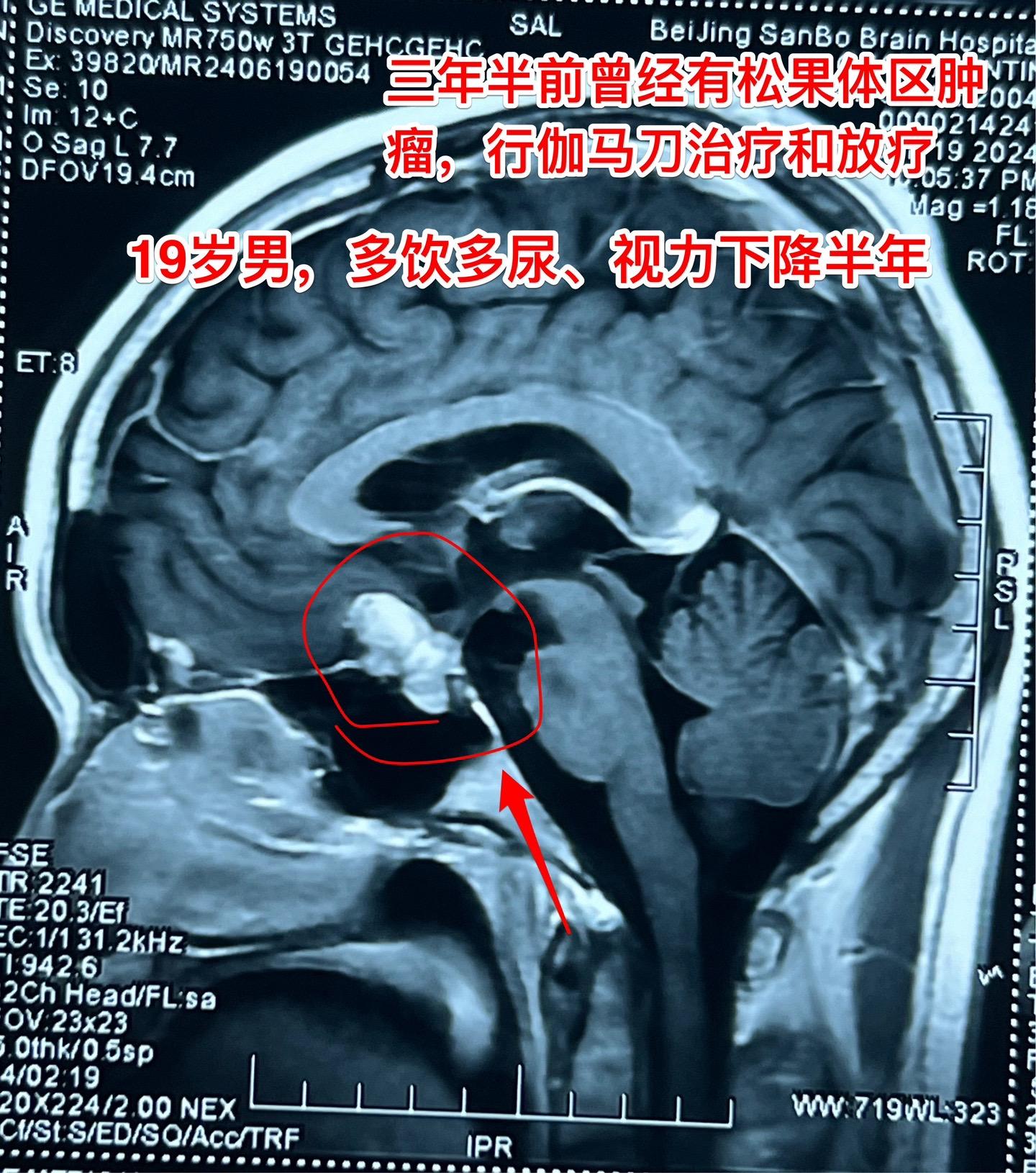 混合性生殖细胞肿瘤复发需要综合治疗。19岁莆田籍男性，三年半前还是新冠...