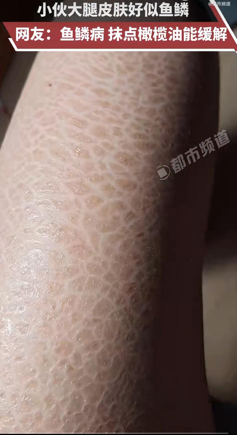 5月1号江苏有件事挺火。一小伙腿上皮肤跟鱼鳞似的，还起皮，网友一看就说是"蛇皮癣